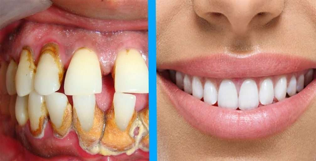 Marketing para dentistas: Resolução 196/2019 do CFO – Liberação do “Antes e depois”
