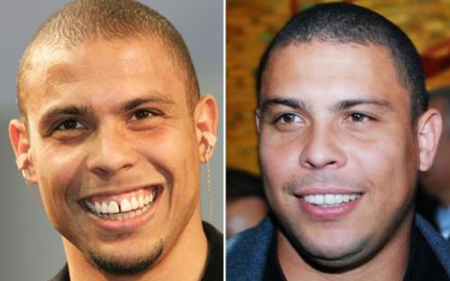 antes de depois dentista ronaldo fenomeno